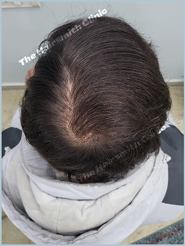 After 7 Months Hair Transplant Result - Best The Hairsmith Clinic Delhi India - Image 2