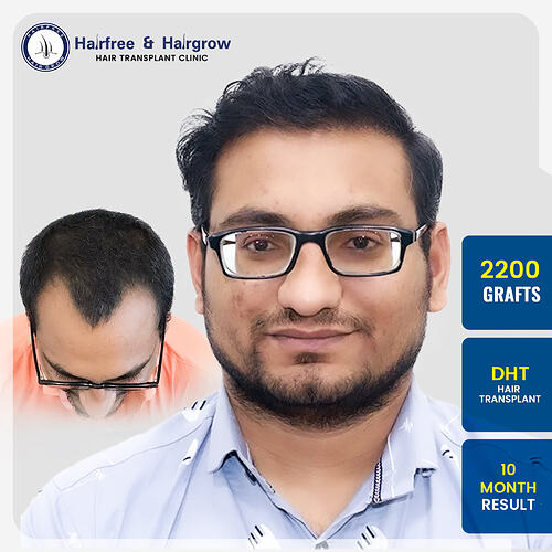 satish-ghinaiya-dht-hair-transplant-result-pune.jpg