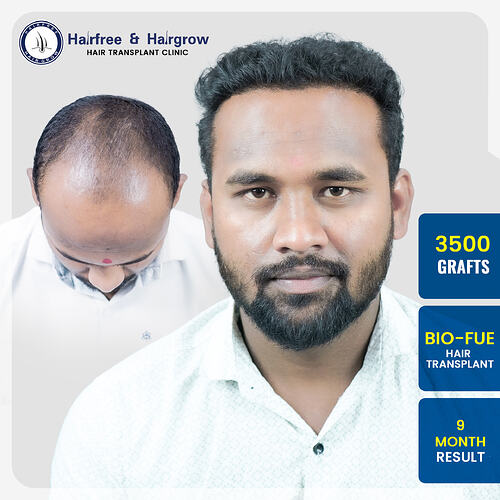 sagar-saudagar-3500-grafts-bio-fue-hair-transplant-9-month-result-pune.jpg