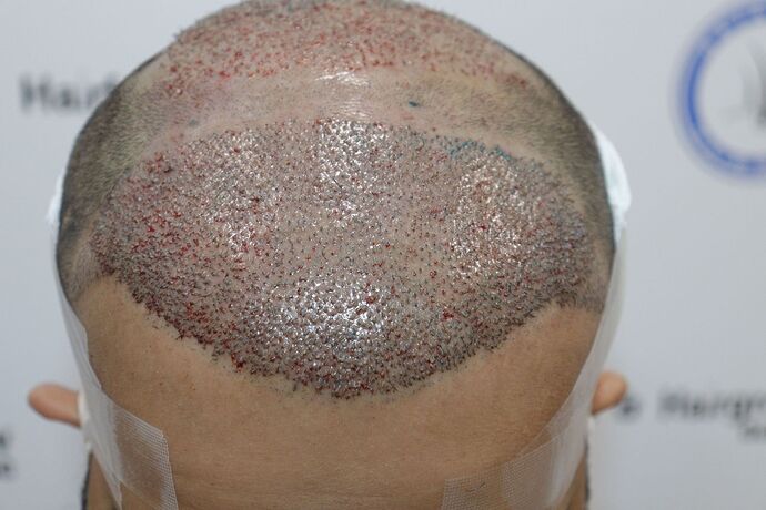 aftertransplant
