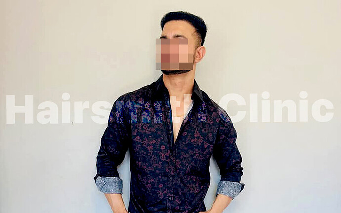 The Hairsmith Clinic - After Hair Transplant result