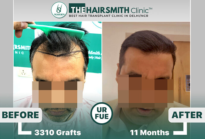 the hairsmith clinic hair transplant result after 11 months