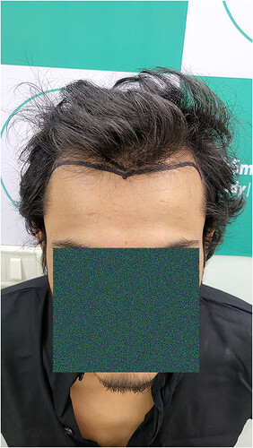 Patient Norwood stages 2 - Before  Picture 2 - The Hairsmith Hair Transplant Clinic
