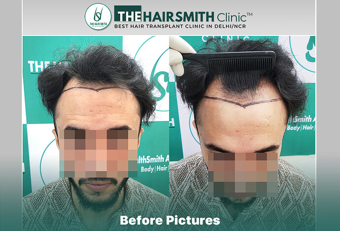 Before Hair Transplant HS 844- The Hairsmith Clinic Delhi India - #hairtransplant