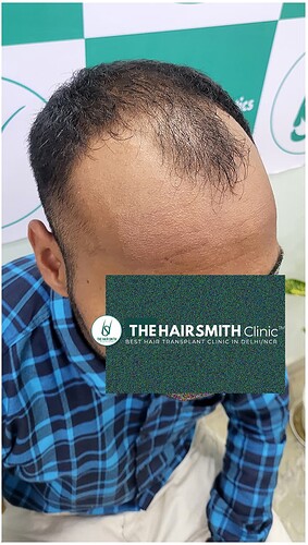 Before Hair Transplant Picture 3 - The Hairsmith Clinic