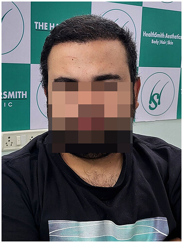 After Hair Transplant Result - The Hairsmith Clinic Delhi India (1)