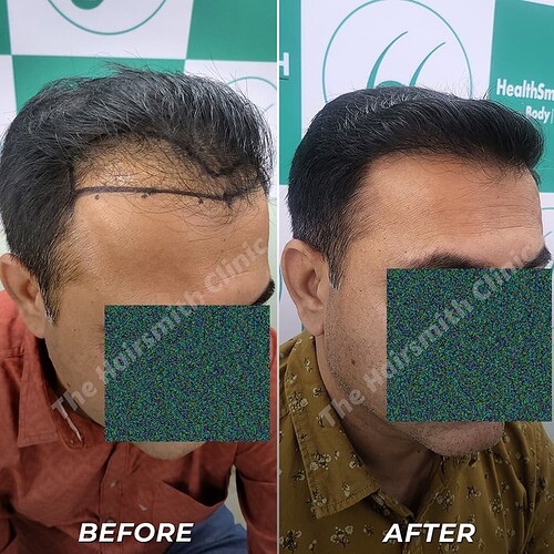 Best Hair Transplant Result - After 10 Months Update - The Hairsmith Clinic Delhi India - 3
