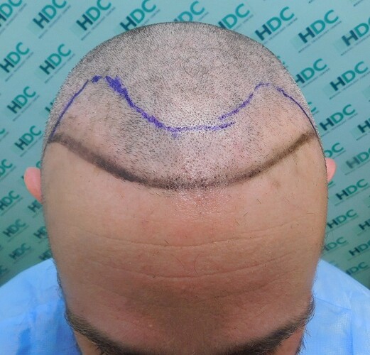 1a Hairline design