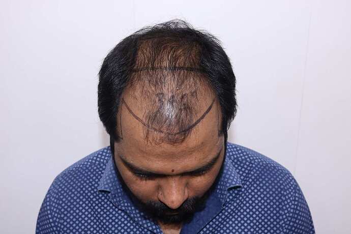 hair line marking