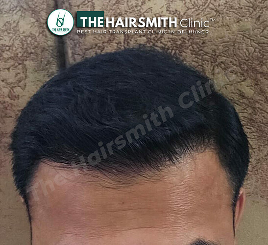 Hair Transplant Result - After 09 Months Update - The Hairsmith Clinic