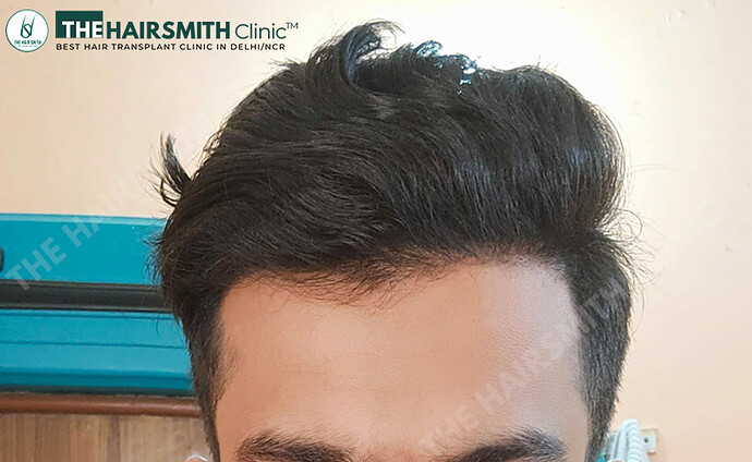 After Hair Transplant - 06 Months Update - Image 1 - The Hairsmith Clinic