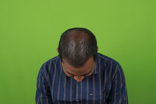 Shedding Phase After Hair Transplant
