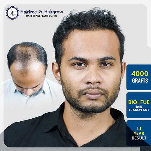 prashant-more-hair-transplant-result-pune-india-4000-grafts-bio-fue-1-1-years-before-after.jpg