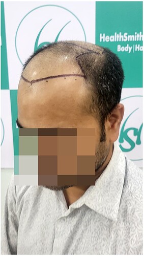 Before Hair Transplant HS 814 - The Hairsmith Clinic Delhi India - 3