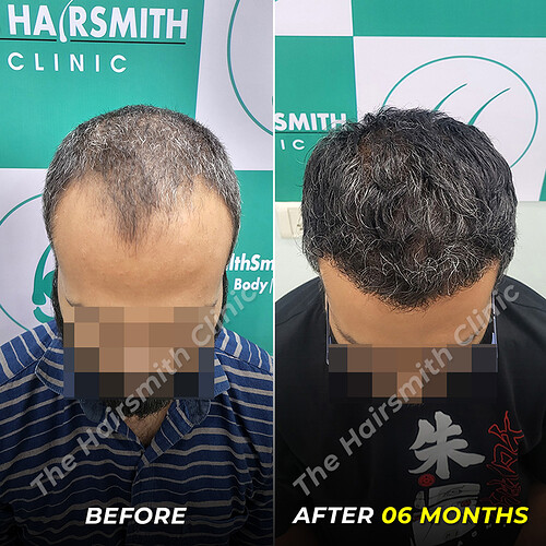 Hair Tarnsplant Befoe and After Result - photo 3 - The Hairsmith Clinic