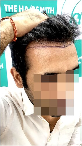 Before Hair Transplant HS 825- The Hairsmith Clinic Delhi India - (3)