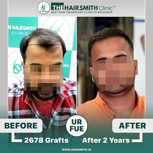 The Hairsmith Clinic Hair Transplant Result - Before and after result