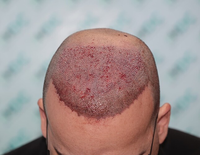 4. FUE1 on 28-02-24 for 4500 Grafts