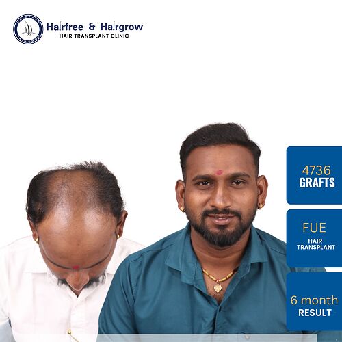 kamlesh-pawar-fue-hair-transplant-result-pune.jpg