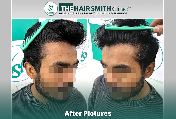 #hairtransplant #thehairsmithclinicdelhi #urfuehairtransplant #affordablehairtransplant