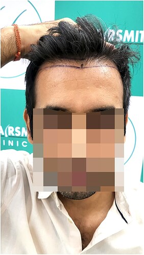 Before Hair Transplant HS 825- The Hairsmith Clinic Delhi India - (1)
