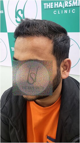 After Hair Transplant Result -04 Months Update - The Hairsmith Clinic (4)