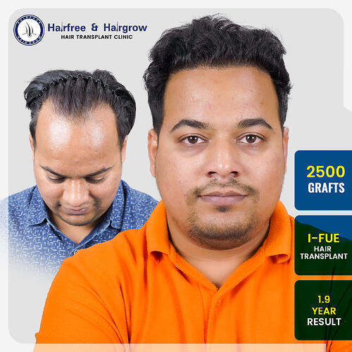 akshay-dhakne-hair-transplant-result-pune-india-i-fue-1-9-years-before-after.jpg
