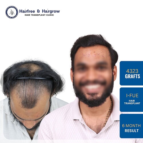 hair-transplant-4323-grafts-6-month-result-pune.jpg (1)