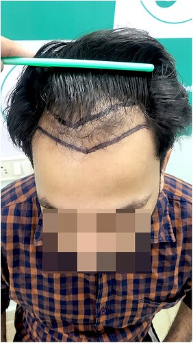 Before Hair Transplant HS 827- The Hairsmith Clinic Delhi India - 2