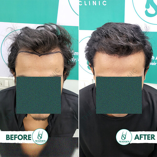 Hairline Hair Transplant Result After 6 months update - The Hairsmith Hair Transplant Clinic 2.PNG