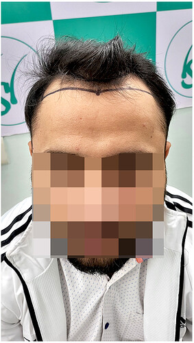 Before Hair Transplant HS 828- The Hairsmith Clinic Delhi India - 1