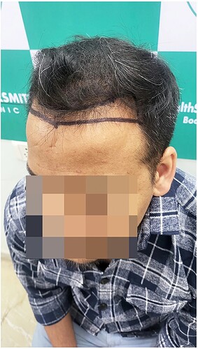 Before Hair Transplant HS 816 - The Hairsmith Clinic Delhi India - (3)