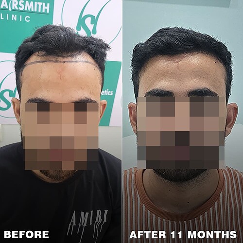 best hair transplant result  after 11 months at the hairsmith clinic - (1)