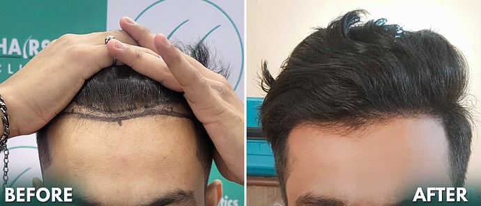 Hair Transplant Result - After 06 Months Update 2 - The Hairsmith Clinic