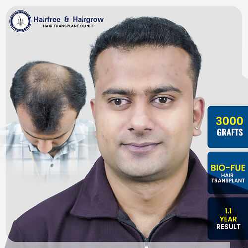 pravin-phoke-3000-grafts-hair-transplant-1-1-year-before-after-result-pune.jpg