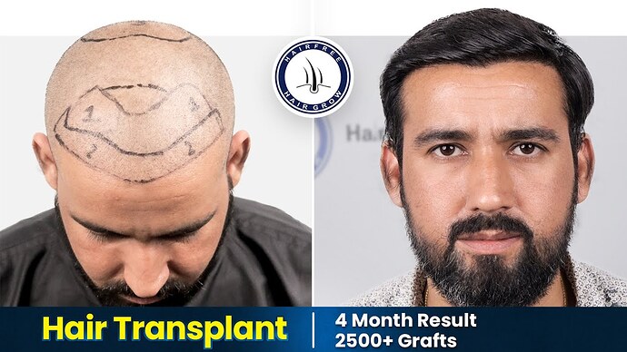 Piyush Purohit hair transplant result