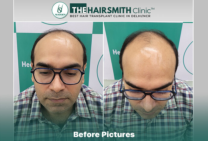 Before Hair Transplant HS 836- The Hairsmith Clinic Delhi India - #hairtransplant #hairlossstage6