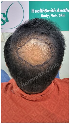 Before Hair Transplant Picture - The Hairsmith Clinic D