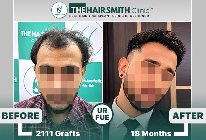 the hairsmith clinic hair transplant result #hairtransplant #hairsmithhairtransplant #hairregrowth