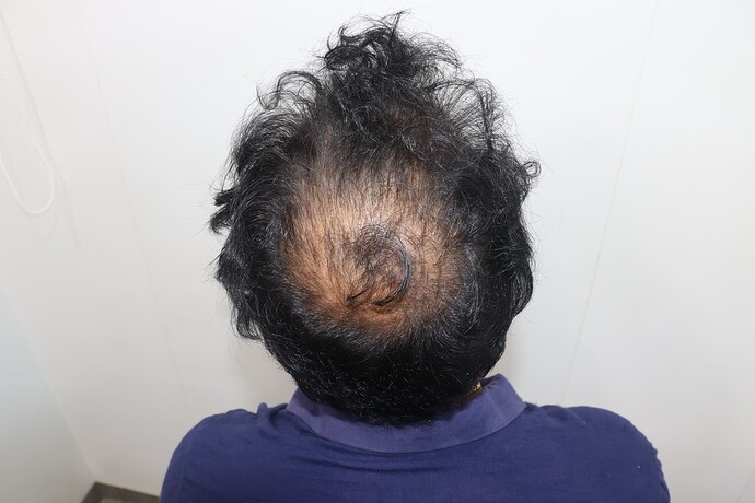 before hair transplant