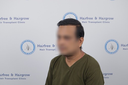 6 month after hair transplant result