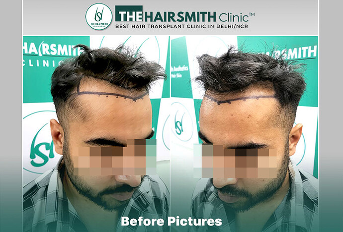 the hairsmith clinic - best hair transplant doctor in india