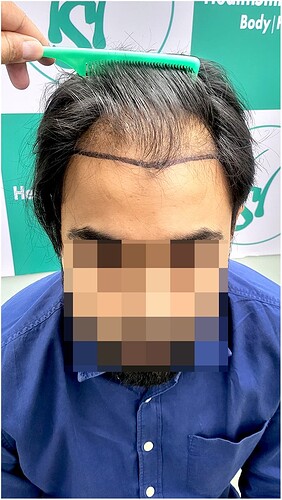 Before Hair Transplant HS 826- The Hairsmith Clinic Delhi India - 1
