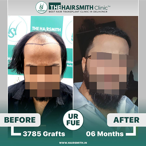The Hairsmith Clinic Hair Transplant Result - Before and after result 2