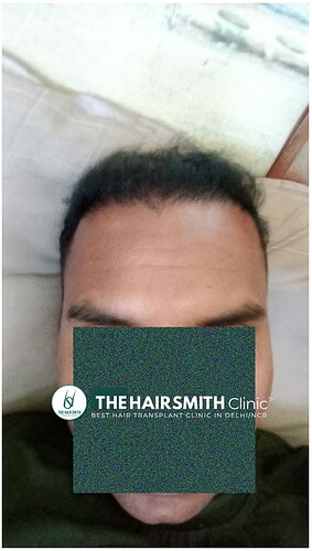 Hair Transplant Result - After 06 Months Update at The Hairsmith Clinic