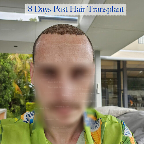 Diamond Hair Clinic in Turkey - Dr. Mehmet Demircioglu - Hair Transplant in Istanbul Turkey - Hair Transplant Patient Conor- 12