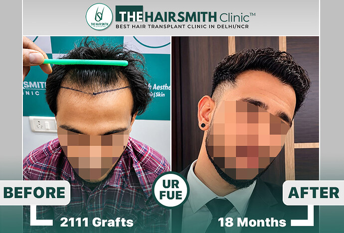 the hairsmith clinic hair transplant result #hairtransplant #hairsmithhairtransplant