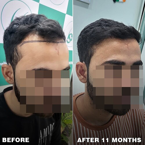 best hair transplant result  after 11 months at the hairsmith clinic - (3)