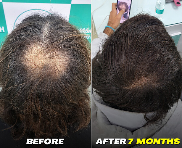 After 7 Months Hair Transplant Result - The Hairsmith Clinic Delhi India - Before After Results - image 2