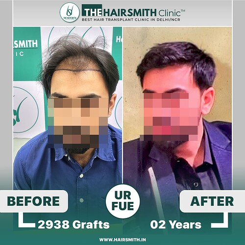 The Hairsmith Clinic Hair Transplant Result - Before and after result